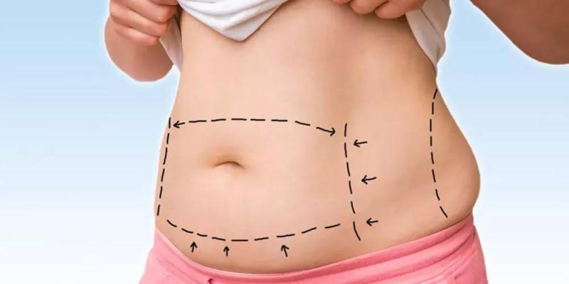 Liposuction Costs in Lebanon for 2026