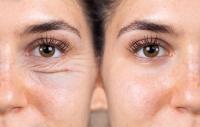 تجميل الجفون تجميل الجفون