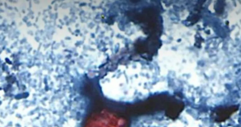 Unprecedented Parasitic Outbreak in Michigan Affects 1000 People
