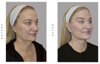 Facelift Face lift