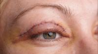 Eyelid beautification Eyelid cosmetic surgery