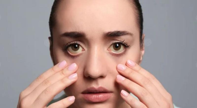 Understanding Yellowing of the Eyes: Causes and When to Seek Medical Help