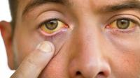 Causes of eye yellowing