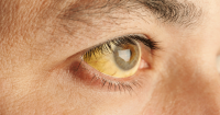 Reasons for yellowing of the eyes