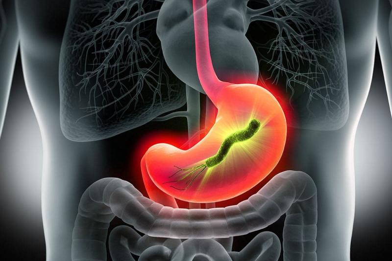 Can H. Pylori Cause Dizziness? Exploring the Connection
