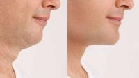Neck tension Neck strain
