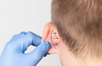 Ear beautification Ear beautification
