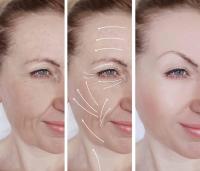 Face lift Facelift