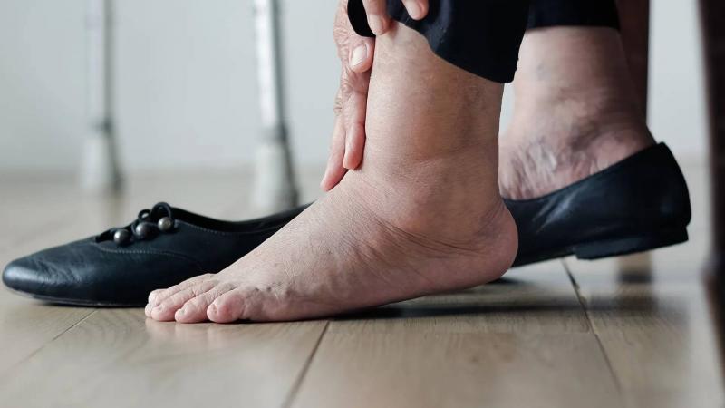 When Swollen Feet Signal Serious Health Issues