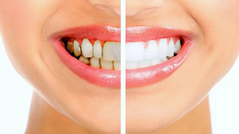 Common Mistakes Leading to Teeth Yellowing