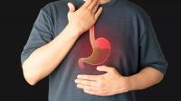 Acid reflux Gastroesophageal reflux