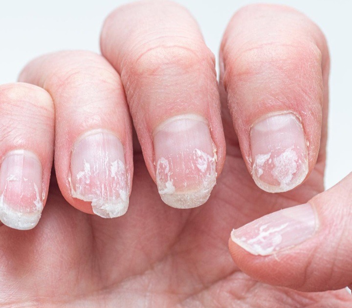 Understanding the Causes of Nail Breakage in Women