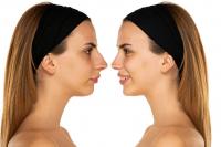 Rhinoplasty Nose beautification