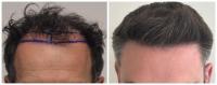 زراعة الشعر في لبنان زراعة الشعر في لبنان