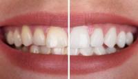 Yellowing of the teeth
