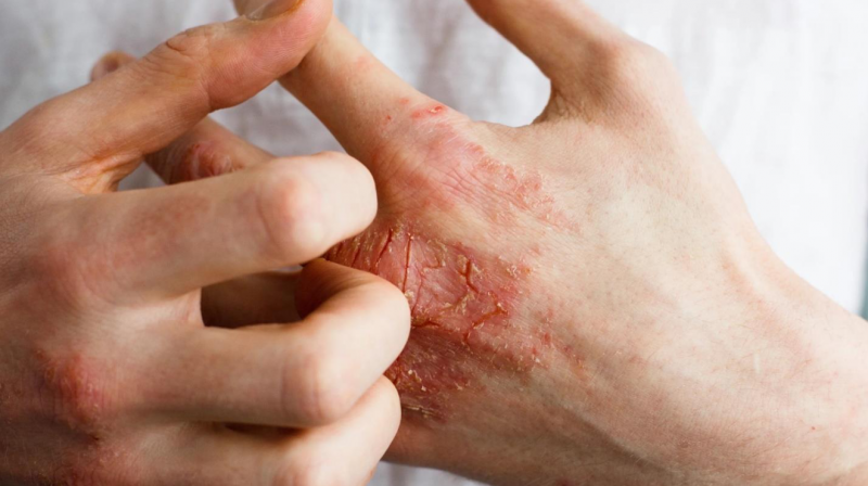 Causes and Treatments for Dry Skin