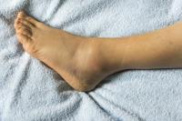 Swelling of the feet