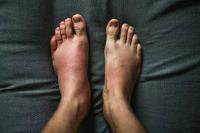 Swelling of the feet