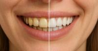 How to whiten teeth How to whiten teeth