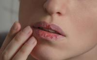Chapped lips Chapped lips