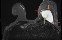 MRI to assess the integrity of breast implants after surgery Magnetic resonance imaging to check the integrity of breast implants after surgery.