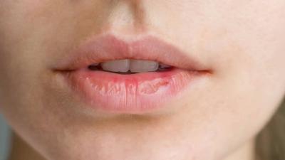 علاج تشقق الشفاه