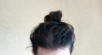 Oily hair loss Oily hair loss