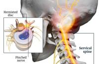 Neck vertebrae problems Neck vertebrae problems