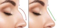 تجميل الأنف تجميل الأنف