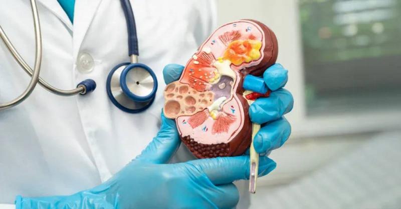Does Kidney Sediment Cause Flank Pain?