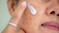 Facial discolorations Facial pigmentation