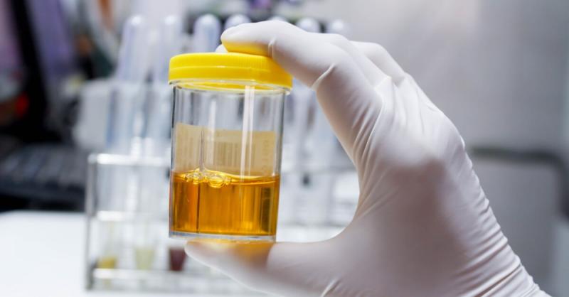 Why Is Your Urine Dark Yellow?