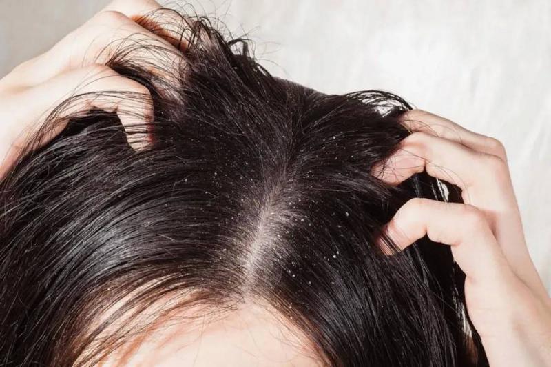 Effective Ways to Banish Dandruff Naturally