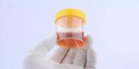 Dark urine Dark urine