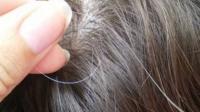 Premature graying in women Premature graying in women