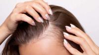Hair loss Hair loss