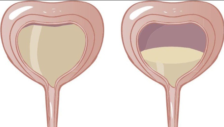 Understanding the Causes of Urinary Retention in Women