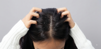 Dandruff Dandruff