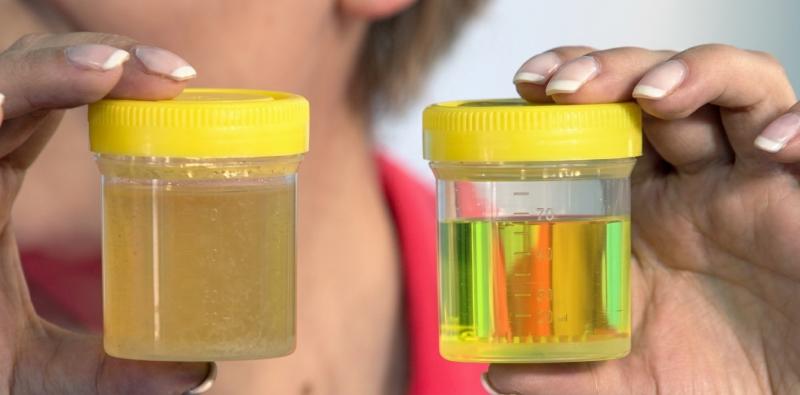 Understanding Sediments in Urine: Causes and What They Mean