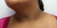 Acanthosis nigricans Acanthosis nigricans