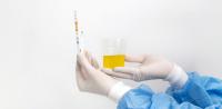 Complete urinalysis Complete urinalysis