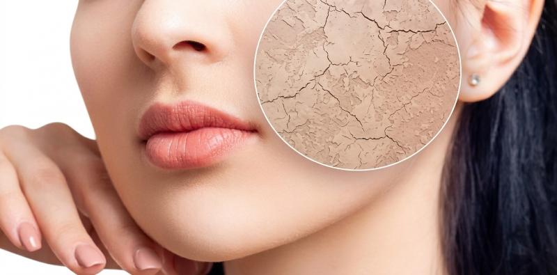 Understanding and Managing Skin Dryness: Causes and Solutions