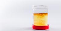 Urinary sediments Urine sediments