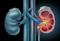 Kidney stones Kidney stones