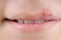 Cold sore Herpes labialis