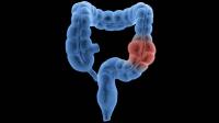 Irritable bowel syndrome Irritable bowel syndrome