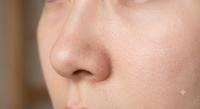 Oily skin Oily skin