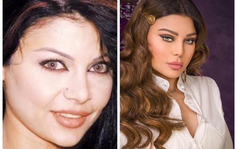 Celebrity Before and After Plastic Surgery Photos Explained