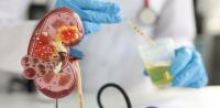 Kidney deposits Kidney deposits