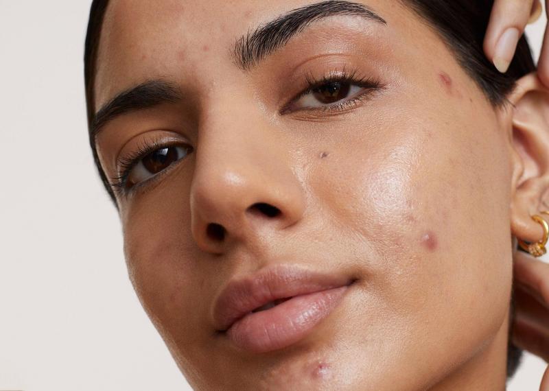 Causes of Acne in Oily Skin: Understanding and Management Tips